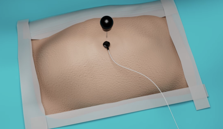 TROKAR YERLEŞTİRME